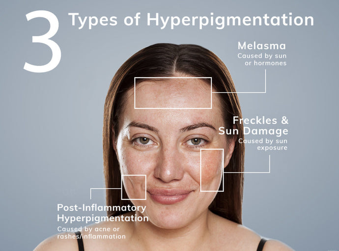 How To Treat Hyperpigmentation