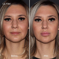 Dermal Fillers
