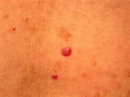 Cherry Angioma Removal