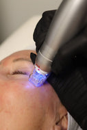 Scarlet SRF RF Microneedling