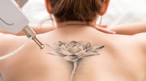 Tattoo Removal XL (up to 36