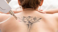 Tattoo Removal Large (up to 16