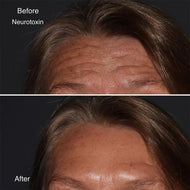 Botox- Nuceiva-Dysport