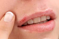 Cold Sore Relief