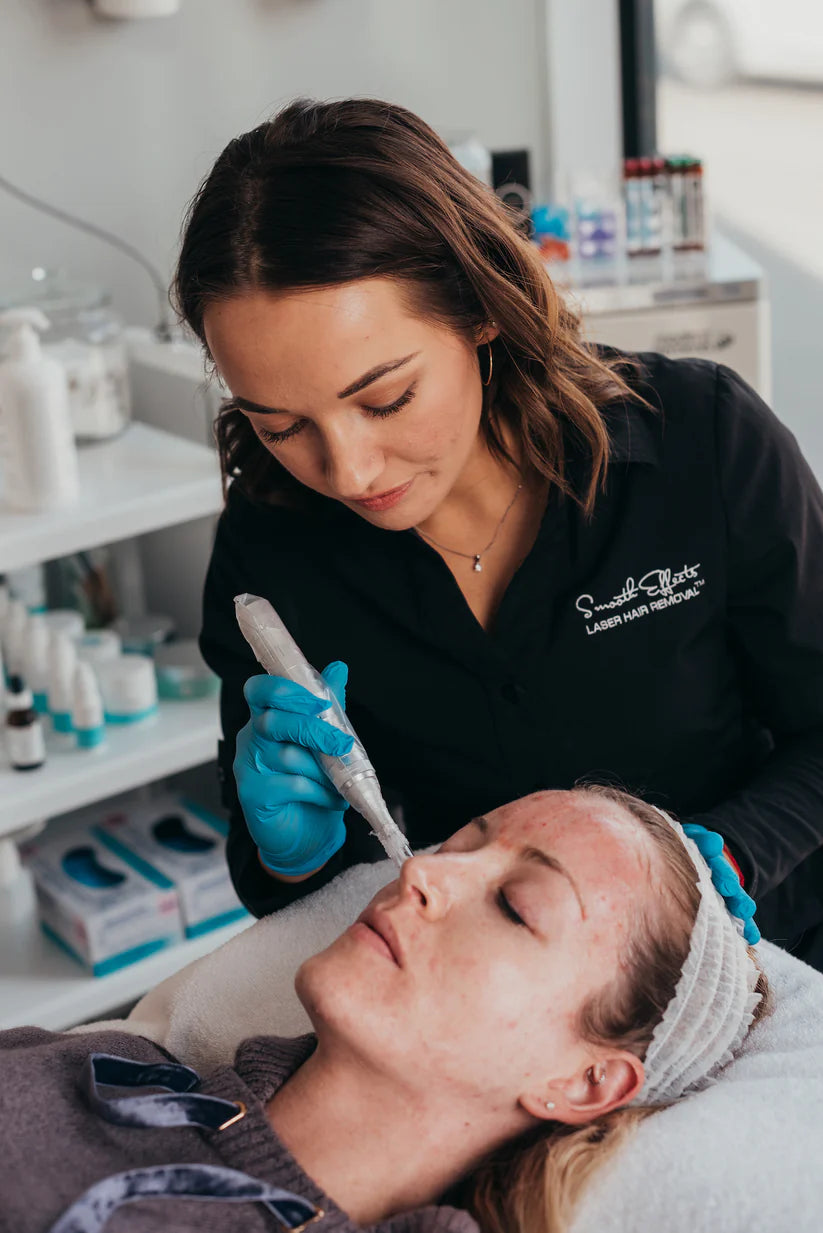 Microneedling with Exosomes