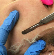 Dermaplaning