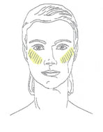 Cheekbone Laser Hair Removal