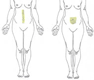 Extended Navel Laser Hair Removal