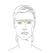 Glabella Laser Hair Removal