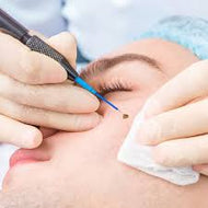 Mole, Skin Tag Removal
