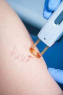 Spider Vein Removal