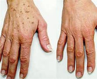 Hands and Knuckles Sun Spot Removal